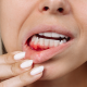Bleeding & Clotting Disorders